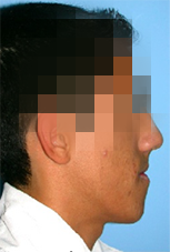 implantes dentales
